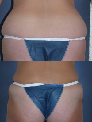 tummy-tuck-p1_5ufB7RB.jpg